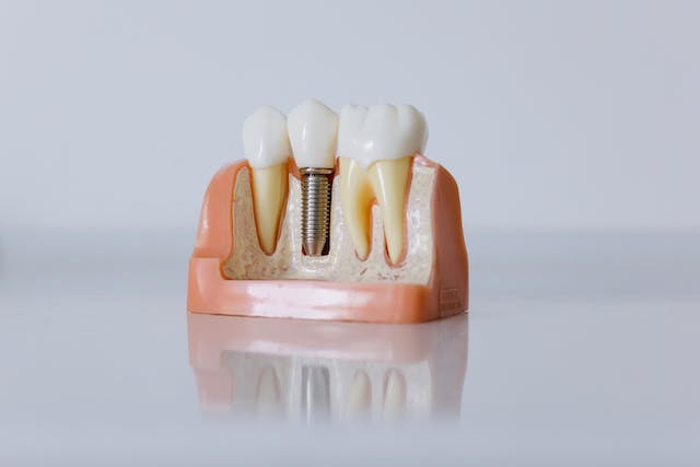 Teeth implants: what’s the worst that can happen?