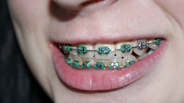 5 top tips for keeping your teeth clean with braces