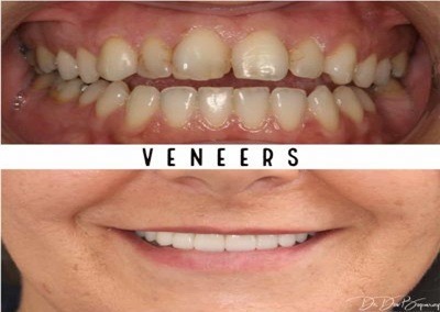 Benefits of Teeth Veneers