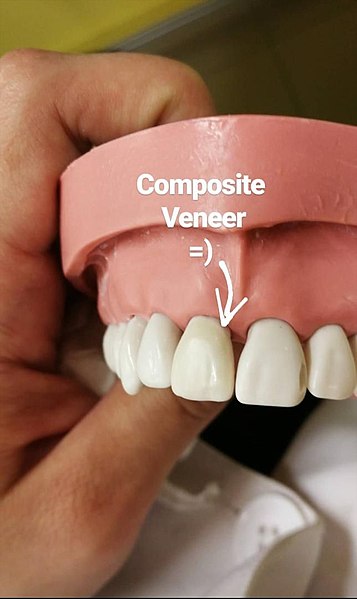 Dental Veneers – The Ideal Teeth Enhancement Procedure