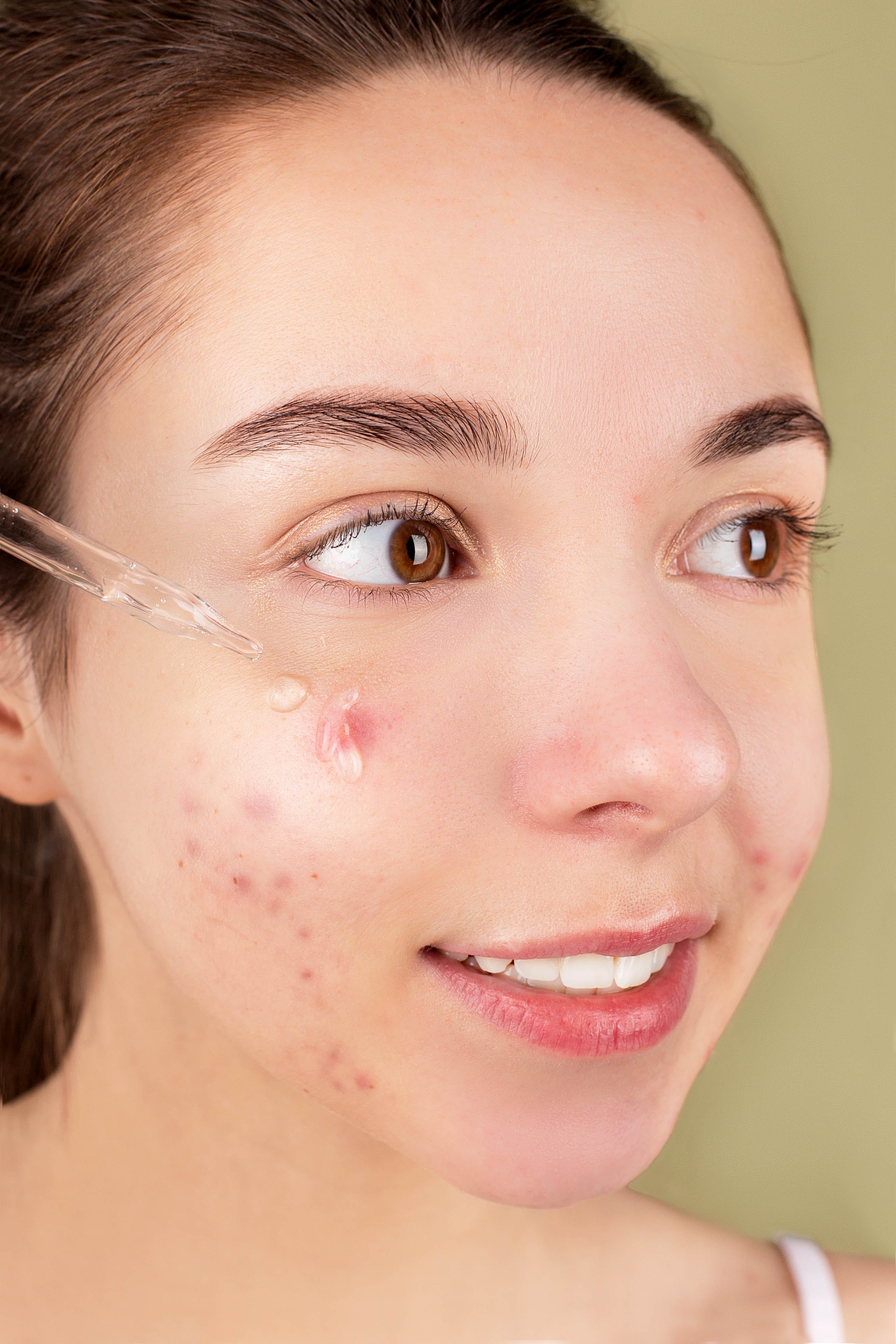 Types & Scar Treatments - Preventing Acne Scars