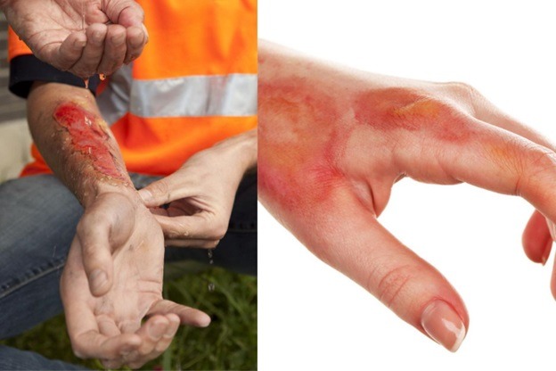 How Using a Defective Product Can Result in Burn Injury and How to Deal With It