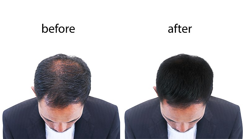 Learn More About Innovative Hair Transplant Systems For Men