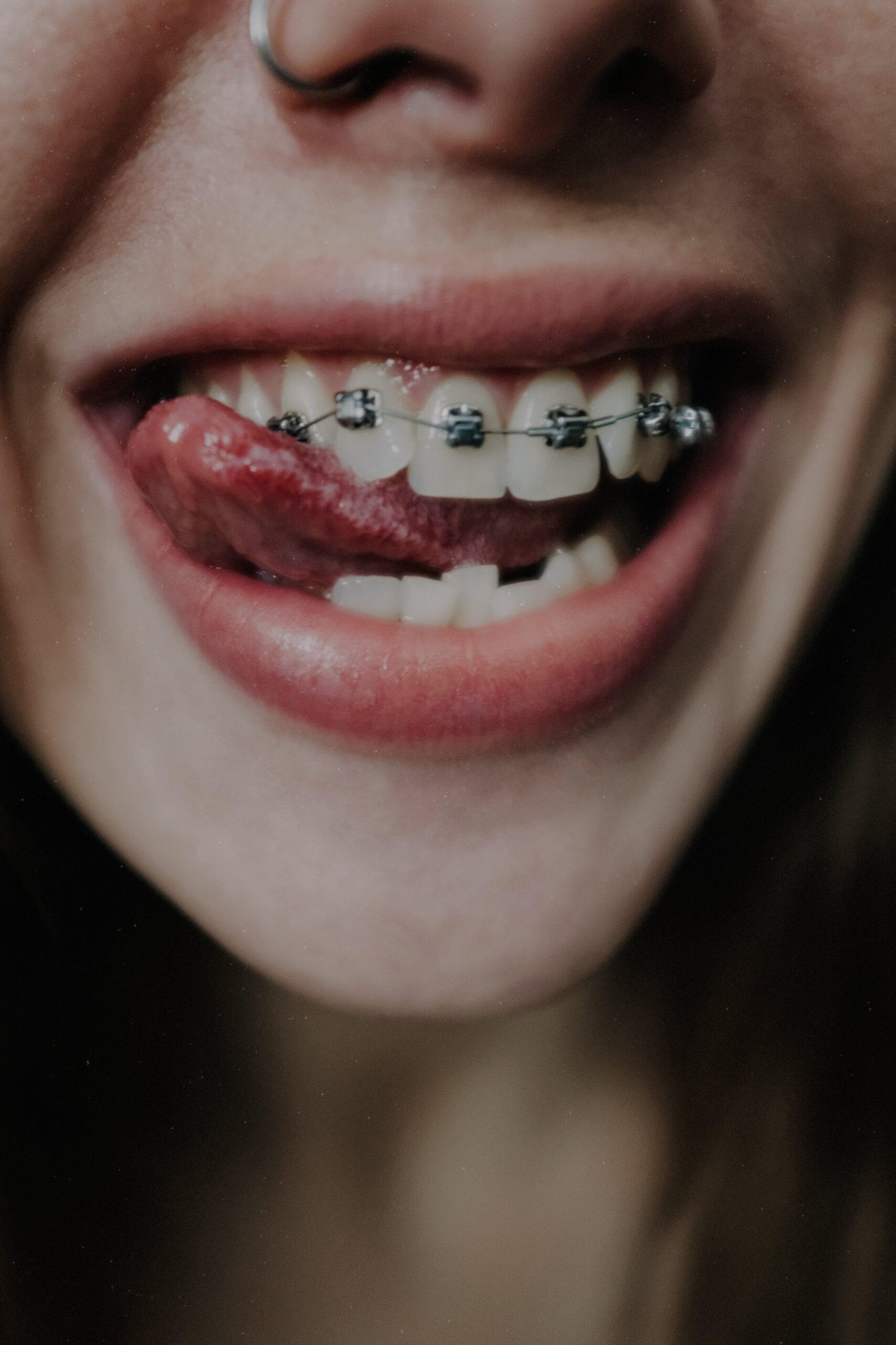 Braces in Carlsbad A Timeline for Your Smile Transformation